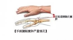 <b>得了腱鞘囊肿你可以这么做</b>