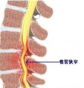 <b>腰腿痛不都是腰间盘突出，还可能是………</b>